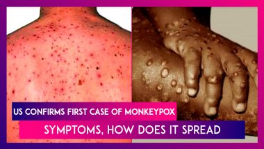US Confirms First Case Of Monkeypox After Cases In UK, Spain, Portugal: Symptoms, How Does It Spread